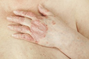 Relación mente cuerpo Componentes psicológicos influyentes en la psoriasis