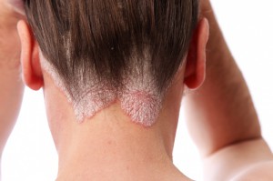 psoriasis en la cabeza-Psicólogos-Gran-Vía