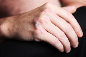 psoriasis en las manosPsicólogos-Gran-Vía